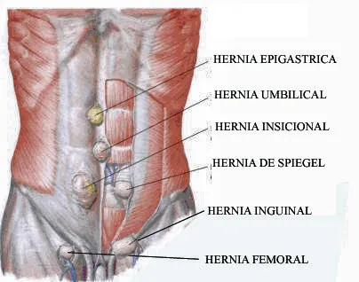 Imagen de Hernias - Clinica Medicci
